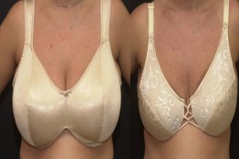 Breast Reduction with Liposuction Only Surgery