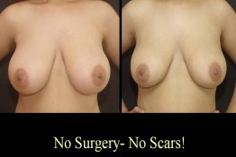 Breast Reduction with Liposuction Only Surgery