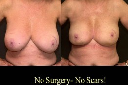 Breast Reduction with Liposuction Only Surgery