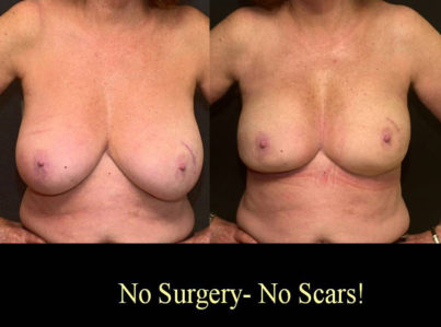 Breast Reduction with Liposuction Only Surgery