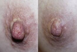 Nipple Reduction Surgery