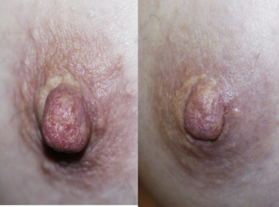 Nipple Reduction Surgery