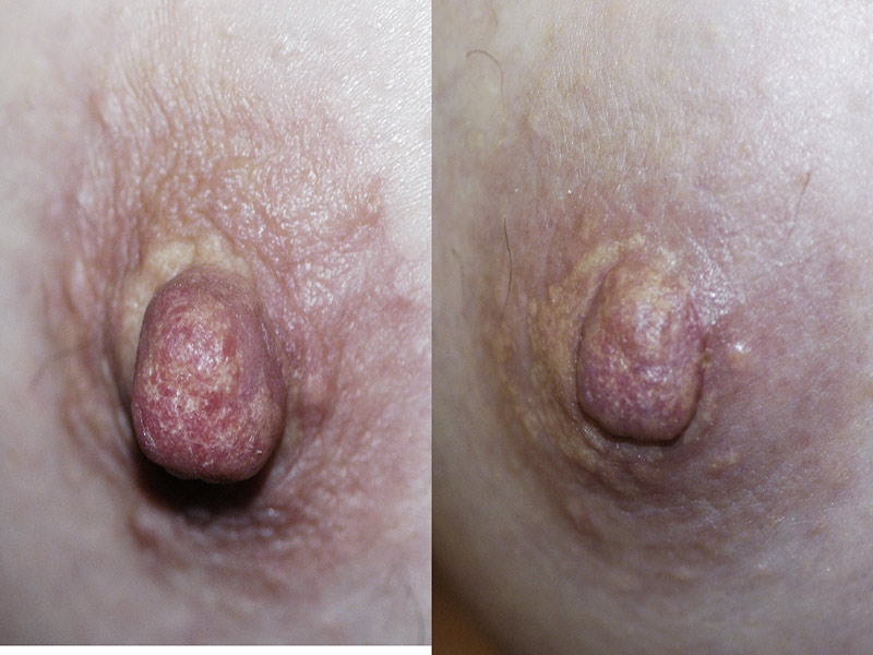 Nipple Reduction Surgery