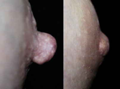 Nipple-Reduction-2