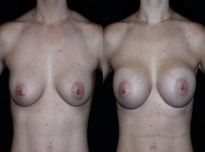 Breast Augmentation Surgery