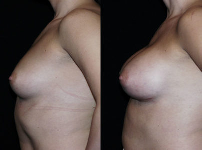 Breast Augmentation Surgery