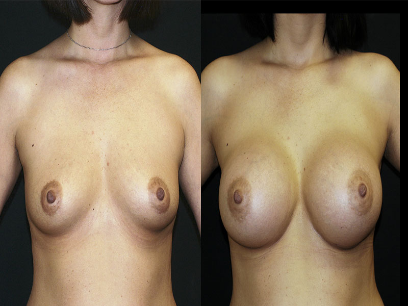 Breast Augmentation Surgery