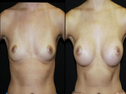 Breast Augmentation Surgery