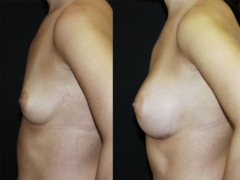 Breast Augmentation Surgery