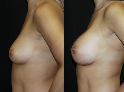 Breast Augmentation Surgery