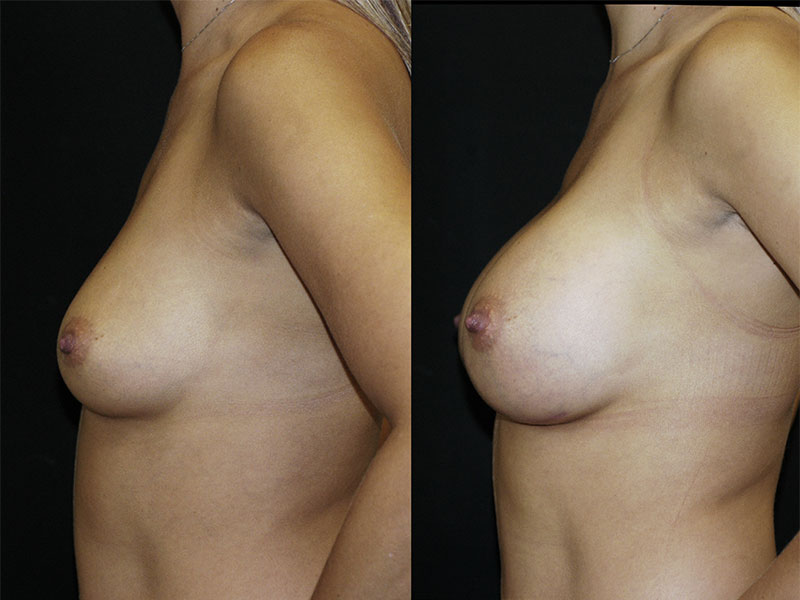 Breast Augmentation Surgery