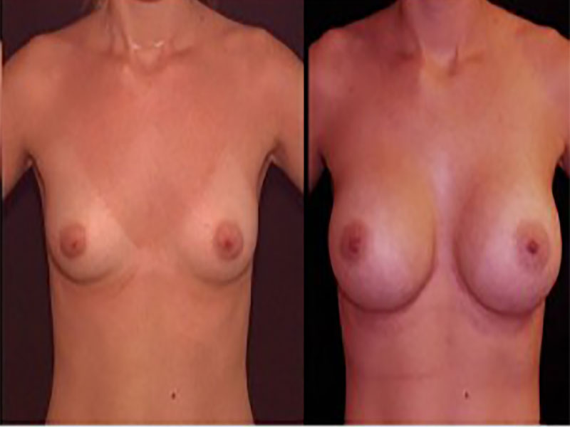 Breast Augmentation Surgery