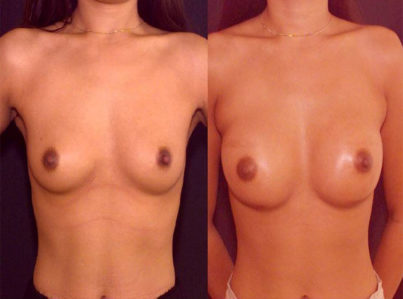 Breast Augmentation Surgery