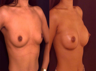 Breast Augmentation Surgery