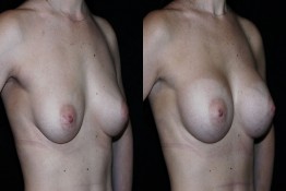 Breast Augmentation Surgery