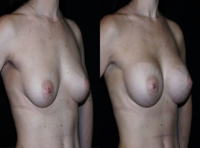 Breast Augmentation Surgery