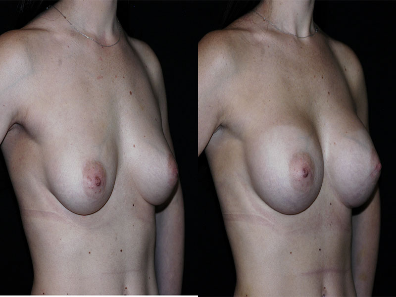 Breast Augmentation Surgery