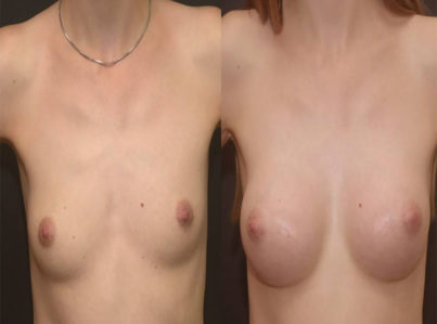 Breast Augmentation Surgery