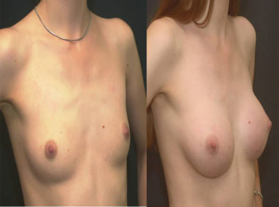 breastaugmentation21