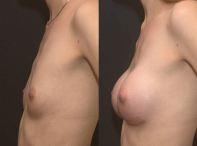 breastaugmentation22