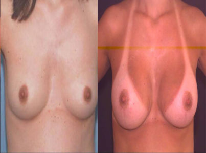 Breast Augmentation Surgery