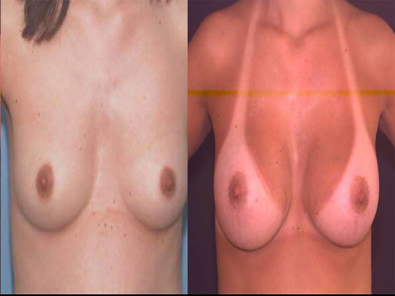 Breast Augmentation Surgery