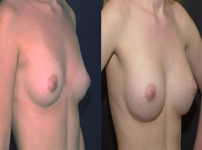 Breast Augmentation Surgery