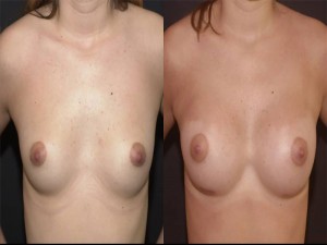 Breast Augmentation Surgery