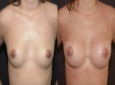 Breast Augmentation Surgery