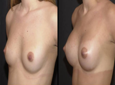 Breast Augmentation Surgery