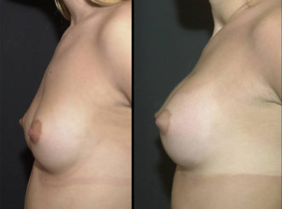 Breast Augmentation Surgery