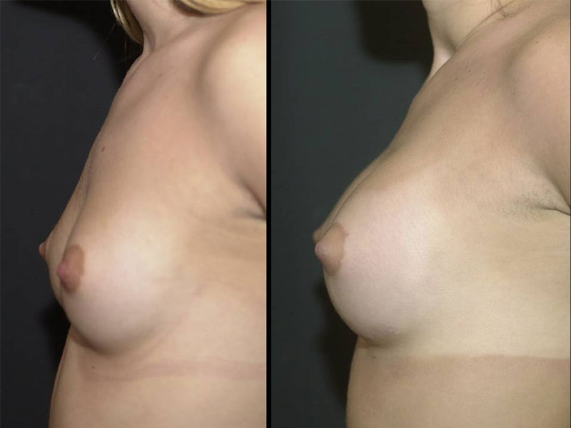 Breast Augmentation Surgery