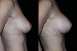 Breast Augmentation Surgery