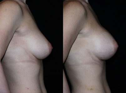 Breast Augmentation Surgery