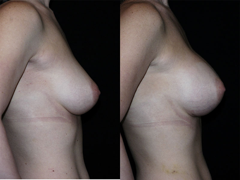 Breast Augmentation Surgery