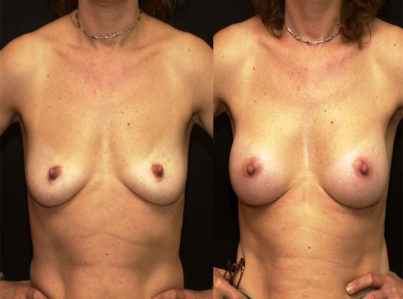 Breast Augmentation Surgery