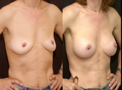 Breast Augmentation Surgery