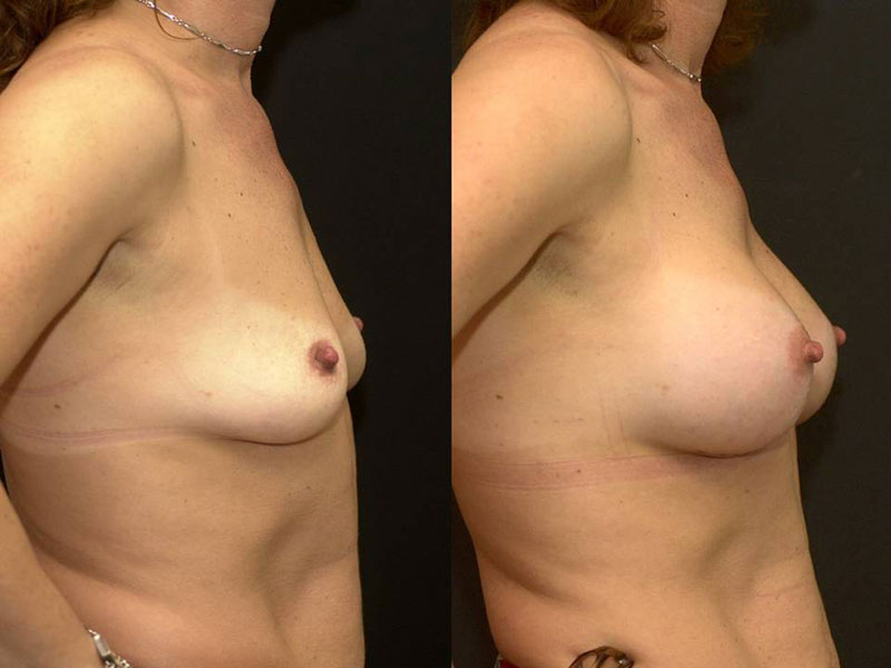 Breast Augmentation Surgery