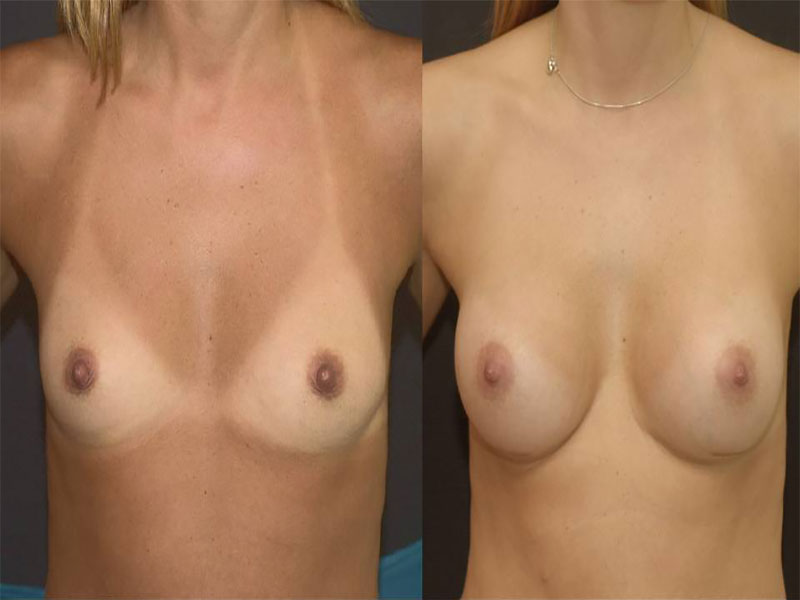 Breast Augmentation Surgery