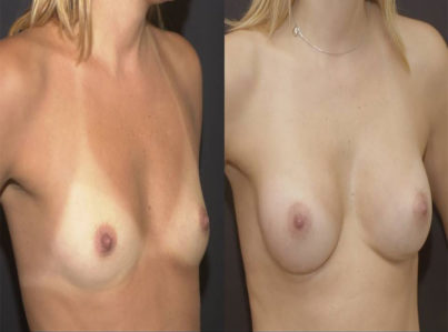 Breast Augmentation Surgery