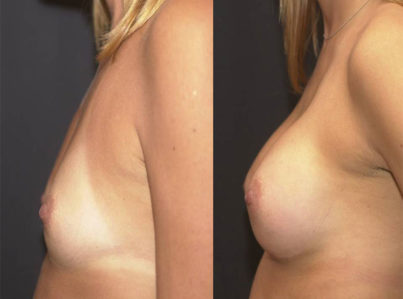 Breast Augmentation Surgery