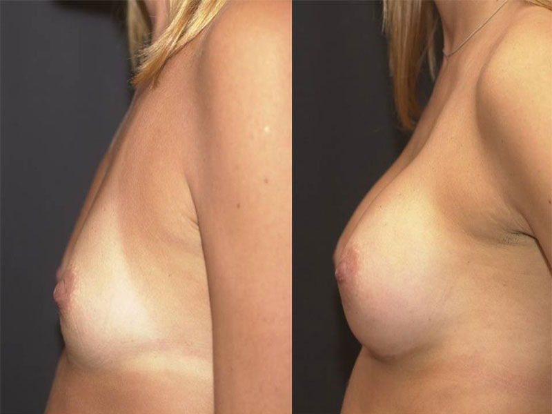 Breast Augmentation Surgery