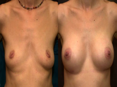 Breast Augmentation Surgery