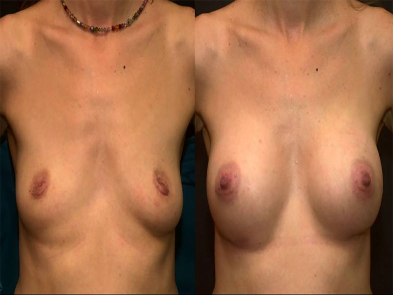 Breast Augmentation Surgery