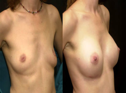 Breast Augmentation Surgery