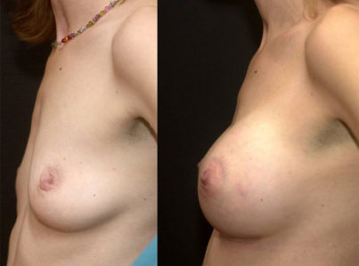 Breast Augmentation Surgery