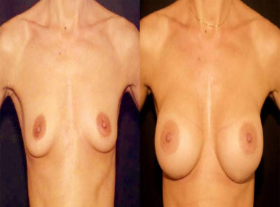 Breast Augmentation Surgery