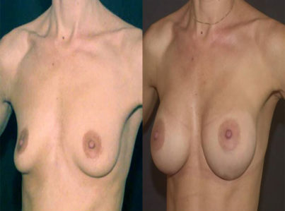 Breast Augmentation Surgery