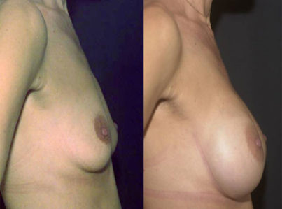 Breast Augmentation Surgery