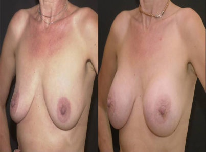 breastaugmentation43